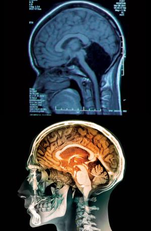 Health Dose – 24 Year Old Woman Survives Without Cerebellum In The Brain!